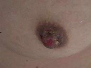 吃瓜能引起湿疹